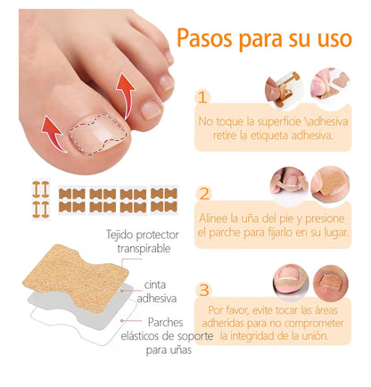 InGrowFix / Kit para uñas encarnadas