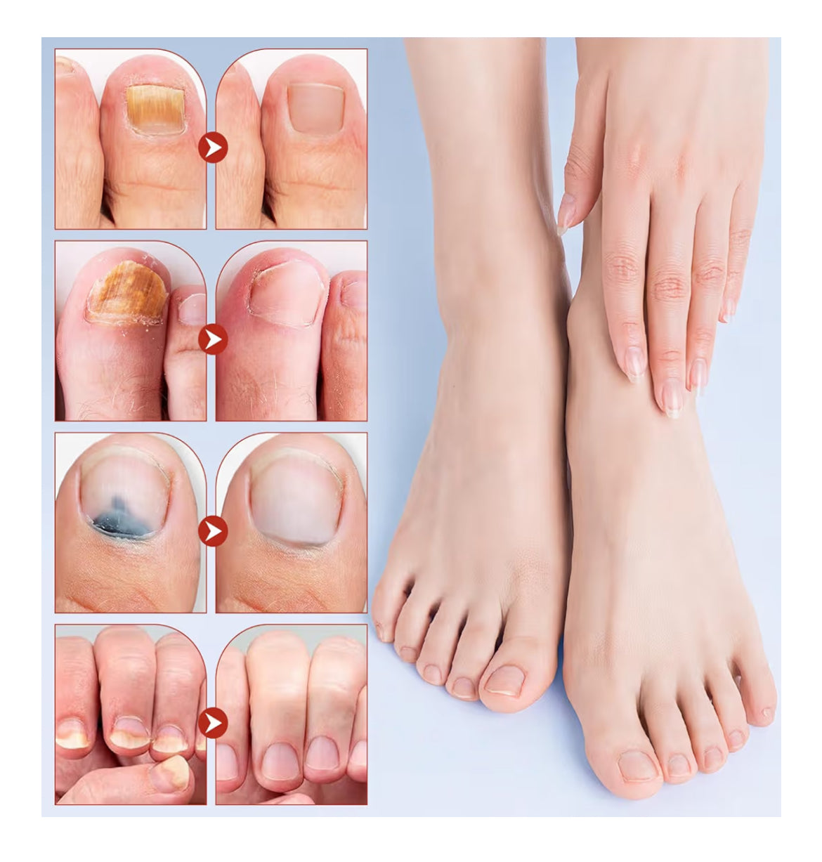 Nail fix / Parche de Hongos