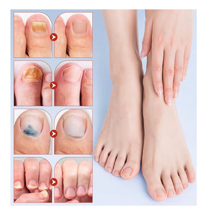 Nail fix / Parche de Hongos